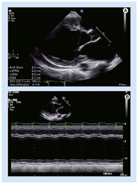 echocardiogram for dilated heart valve.